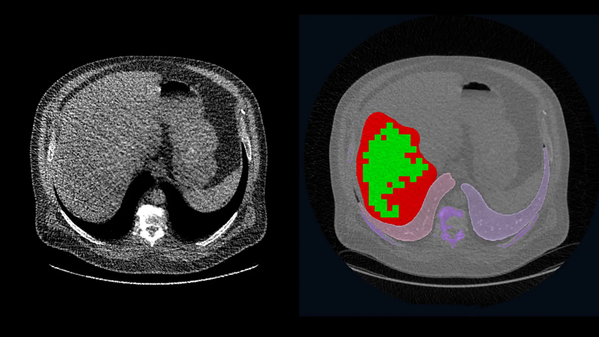Karaciğer Görüntüleme Testleri (Ultrason, MR, BT) ve Sonuçların Yorumlanması